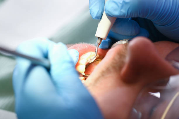 Best Emergency Treatment for Oral Infections in Perris, CA