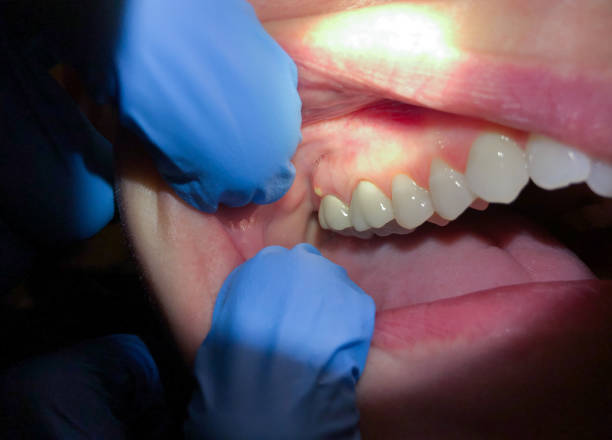 Best Broken or Chipped Tooth Repair in Perris, CA